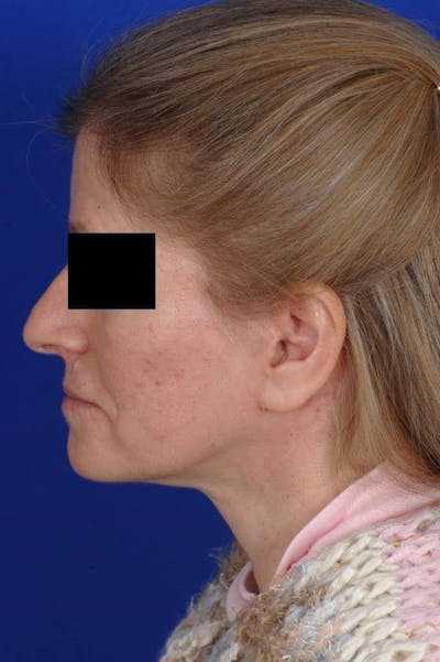 Neck Lift Before & After Gallery - Patient 338310 - Image 2