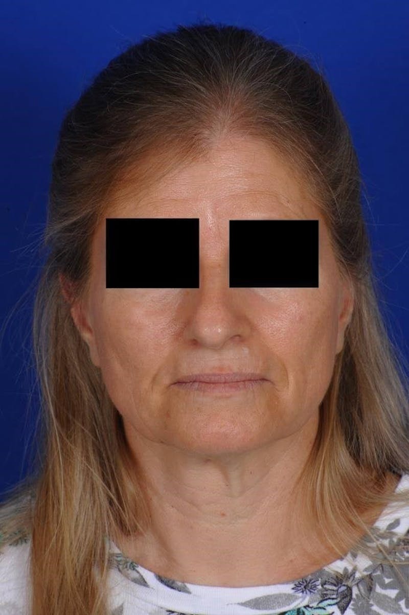 Neck Lift Before & After Gallery - Patient 338310 - Image 3