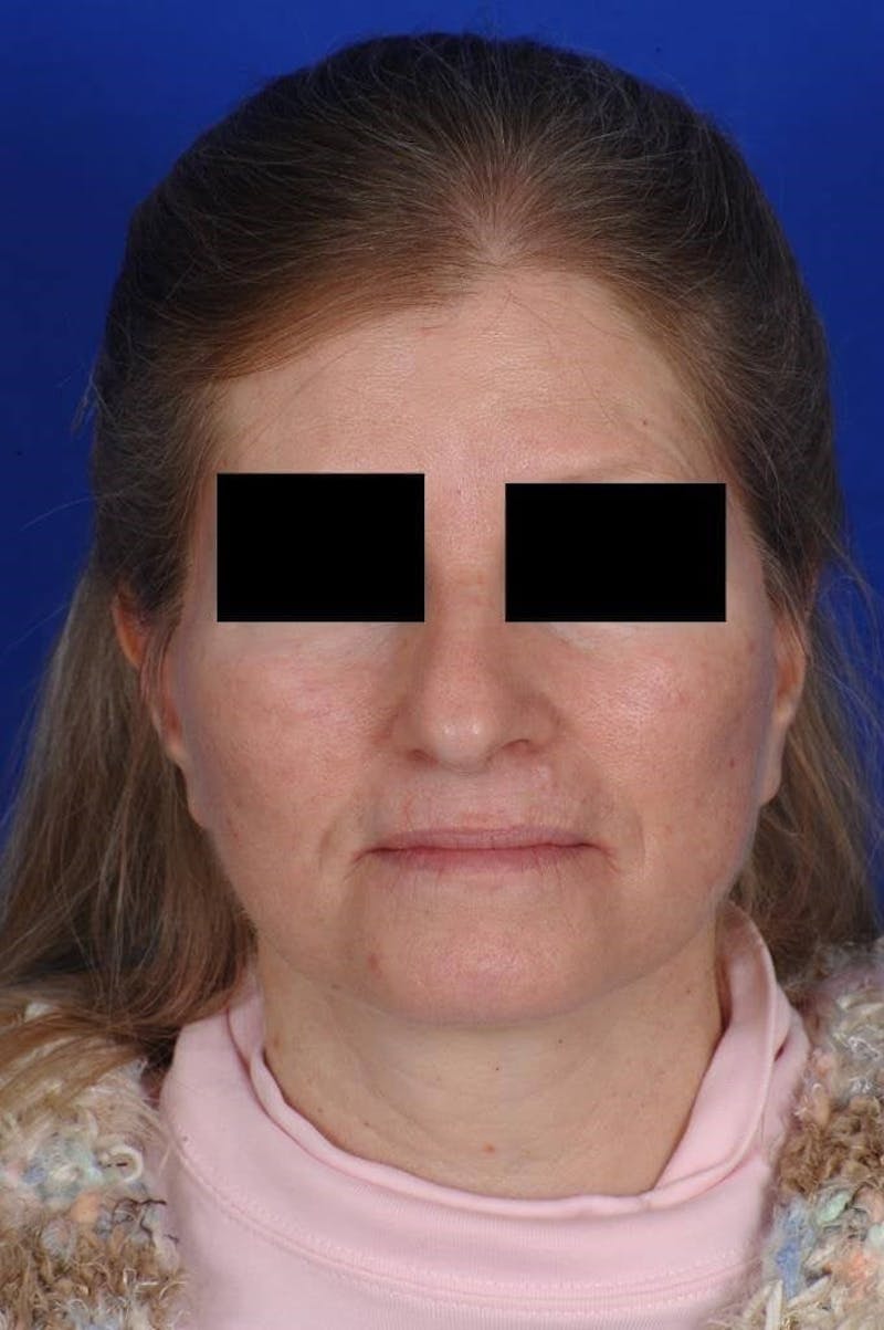 Neck Lift Before & After Gallery - Patient 338310 - Image 4