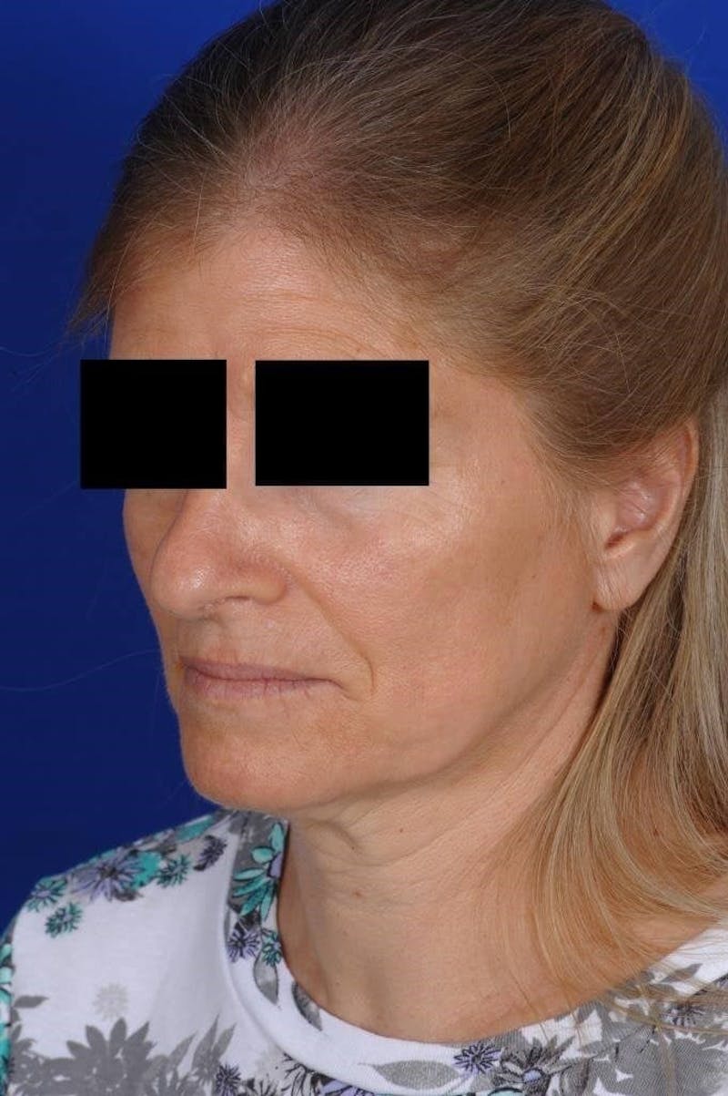 Neck Lift Before & After Gallery - Patient 338310 - Image 5