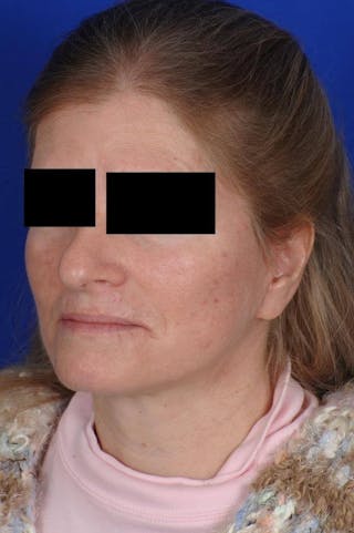 Neck Lift Before & After Gallery - Patient 338310 - Image 6