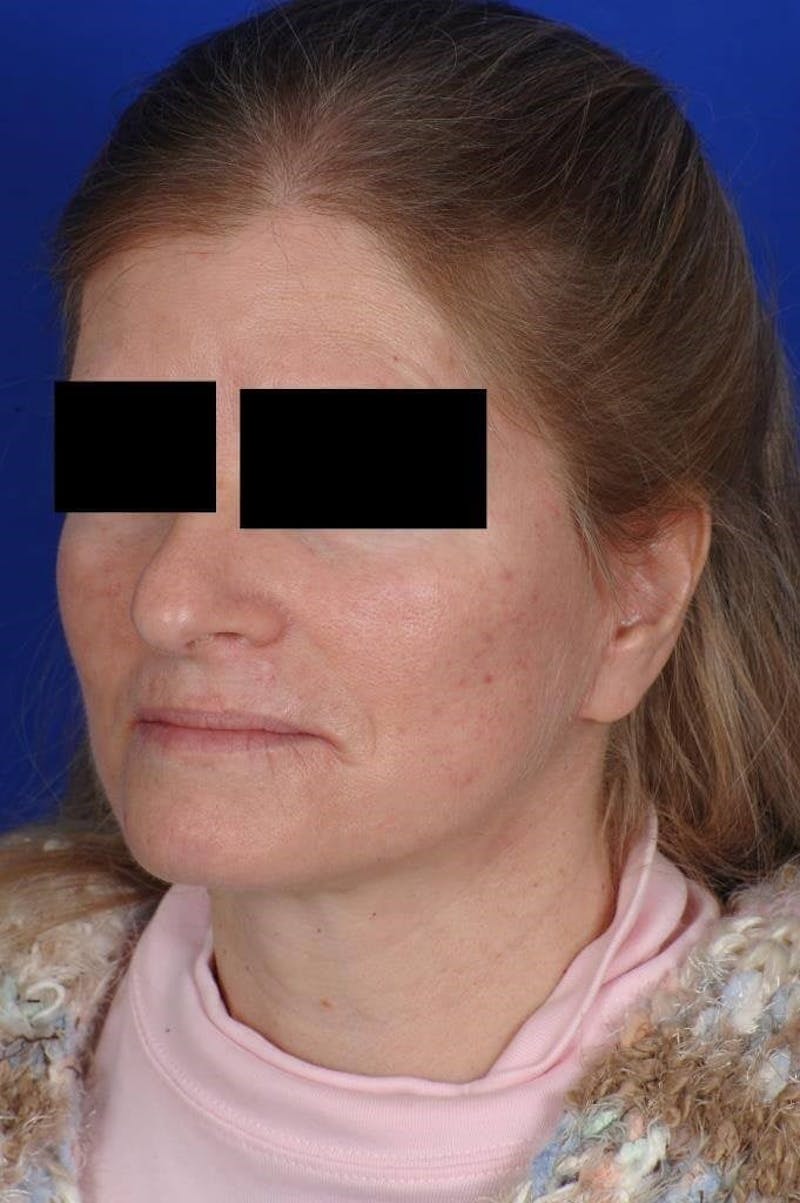 Neck Lift Before & After Gallery - Patient 338310 - Image 6