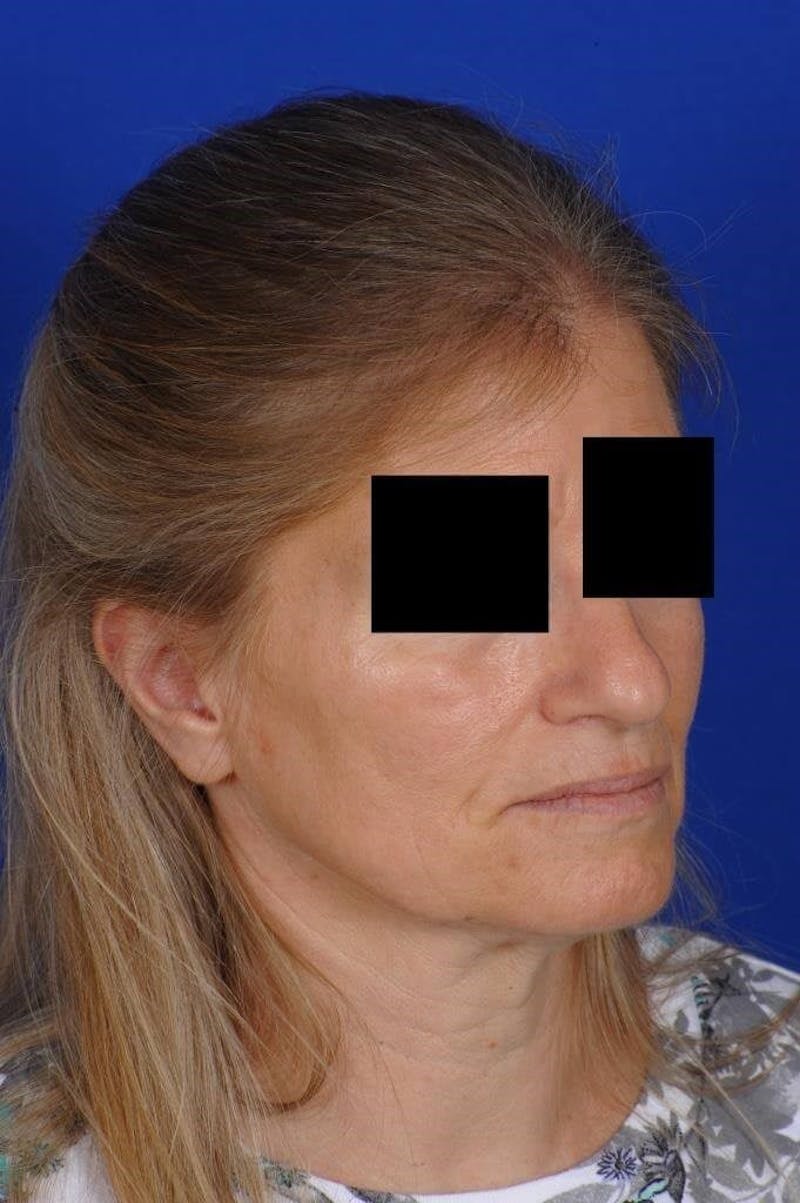 Neck Lift Before & After Gallery - Patient 338310 - Image 7