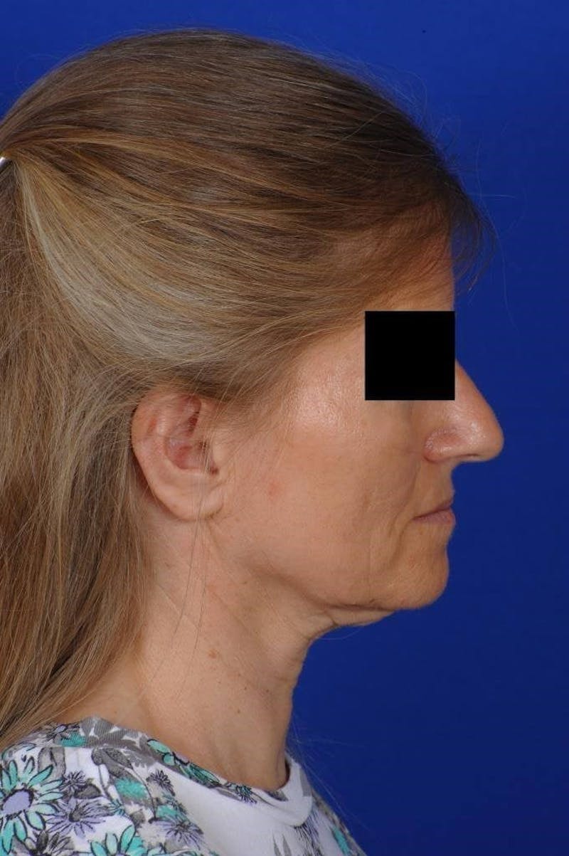 Neck Lift Before & After Gallery - Patient 338310 - Image 9