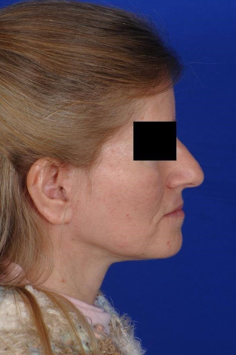 Neck Lift Before & After Gallery - Patient 338310 - Image 10