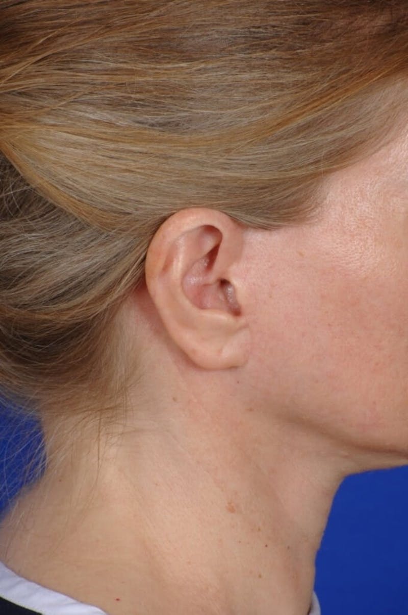 Neck Lift Before & After Gallery - Patient 338310 - Image 11