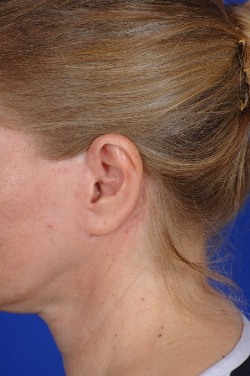 Neck Lift Before & After Gallery - Patient 338310 - Image 12
