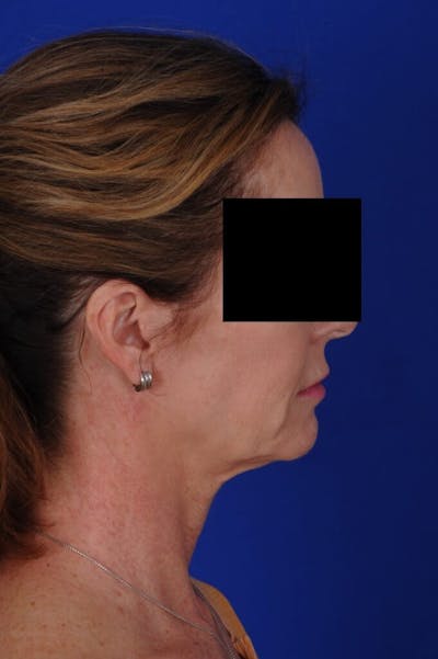 Neck Lift Before & After Gallery - Patient 767487 - Image 1