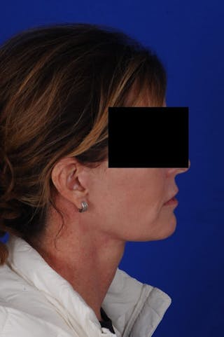 Neck Lift Before & After Gallery - Patient 767487 - Image 2