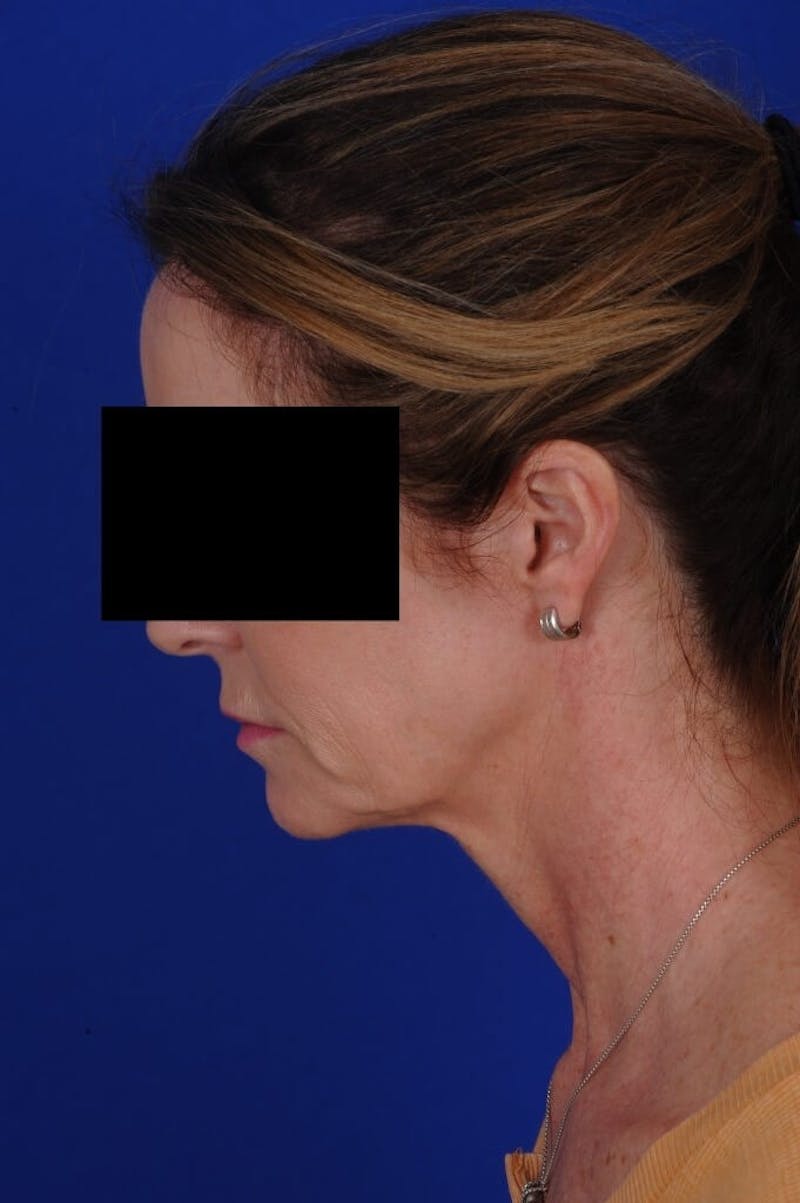 Neck Lift Before & After Gallery - Patient 767487 - Image 9