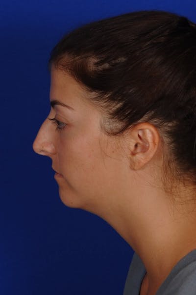 Neck Lift Before & After Gallery - Patient 398505 - Image 1