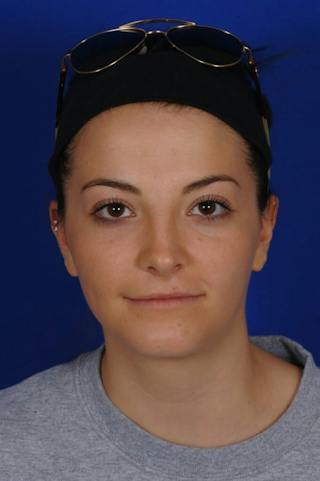 Neck Lift Before & After Gallery - Patient 398505 - Image 4