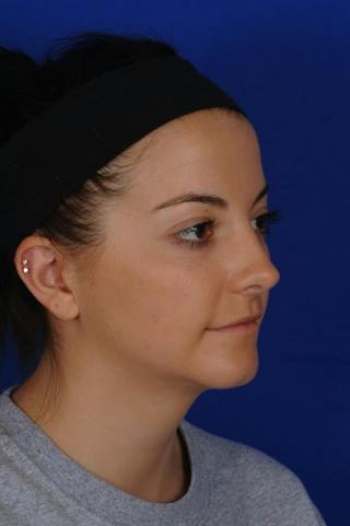 Neck Lift Before & After Gallery - Patient 398505 - Image 6