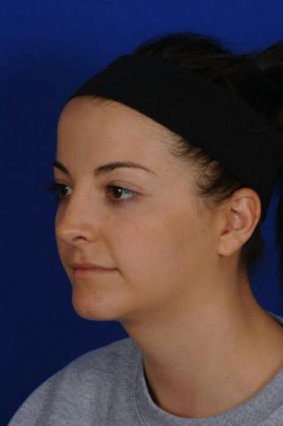 Neck Lift Before & After Gallery - Patient 398505 - Image 8