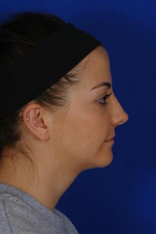 Neck Lift Before & After Gallery - Patient 398505 - Image 10