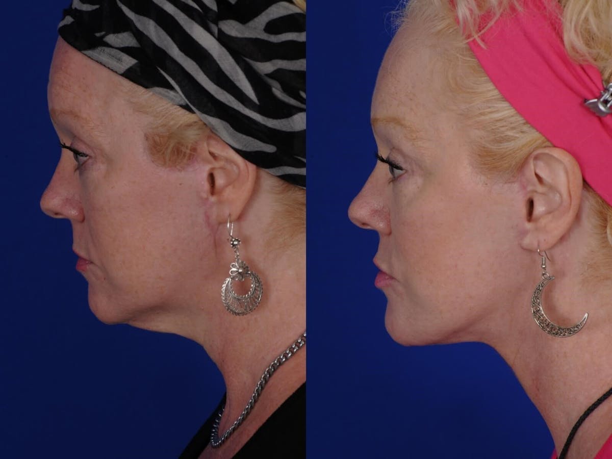Scar Revision Before & After Gallery - Patient 156938 - Image 1