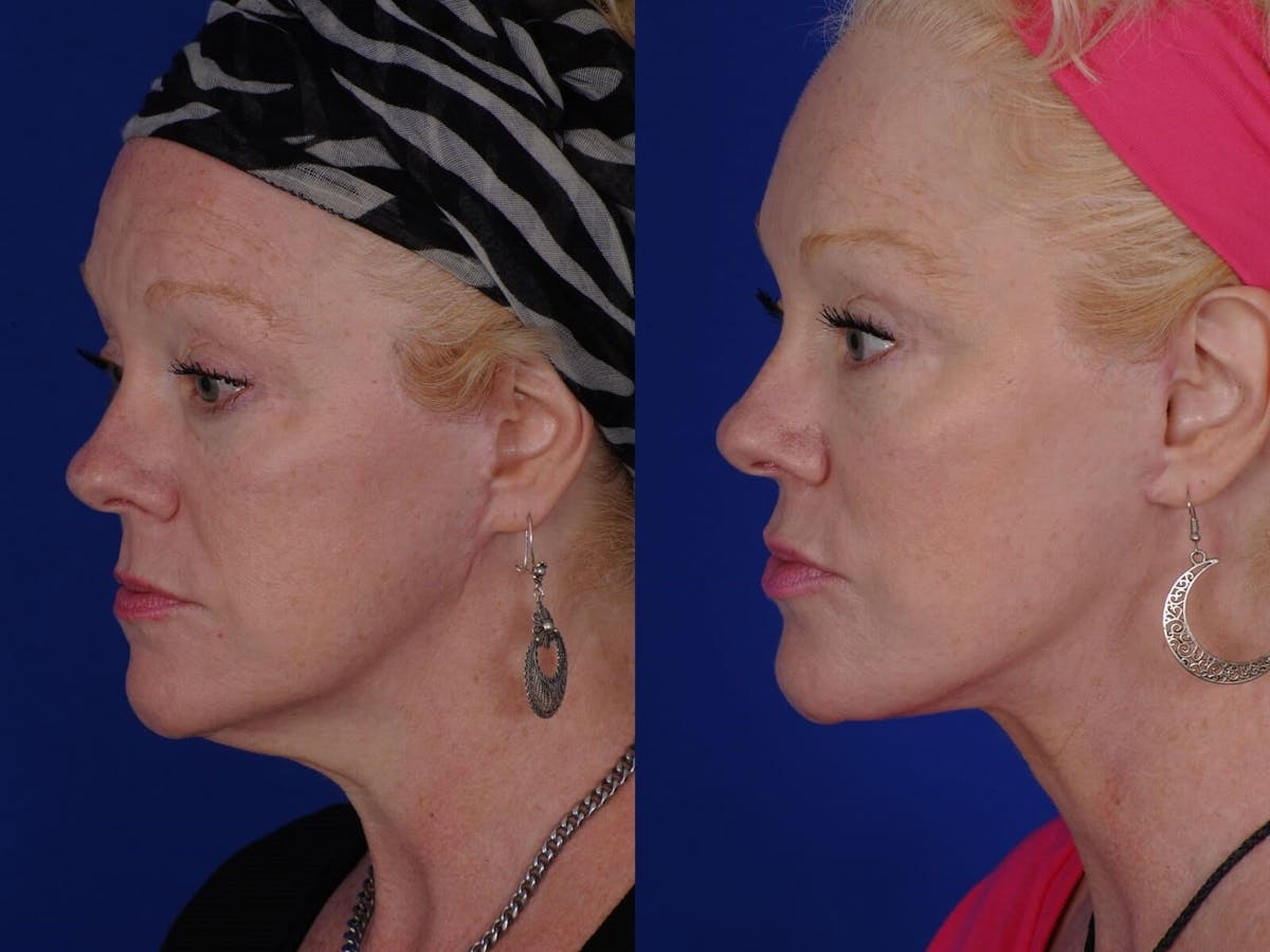 Scar Revision Before & After Gallery - Patient 156938 - Image 2