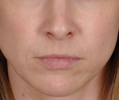Restylane Before & After Gallery - Patient 339492 - Image 1