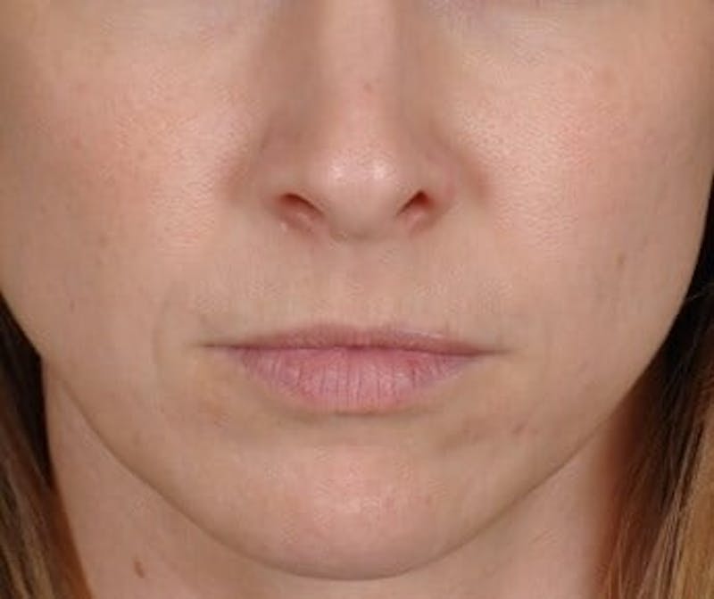 Restylane Before & After Gallery - Patient 339492 - Image 1