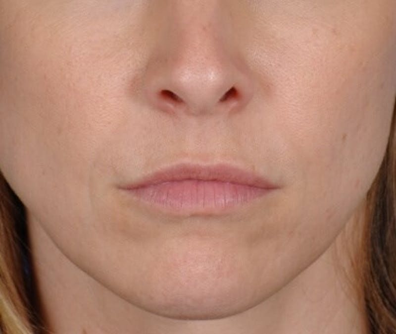 Restylane Before & After Gallery - Patient 339492 - Image 2