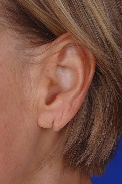 Earlobe Repair Before & After Gallery - Patient 408882 - Image 1