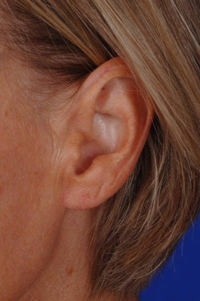 Earlobe Repair Before & After Gallery - Patient 408882 - Image 2