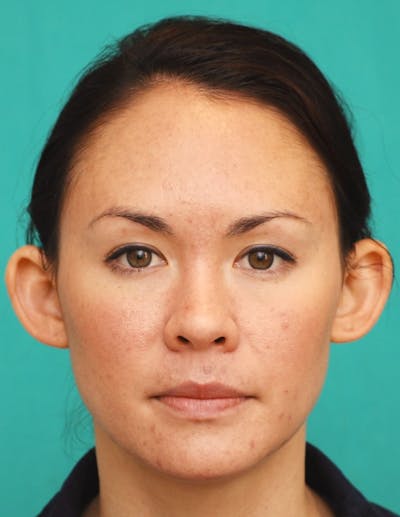 Ear Surgery Before & After Gallery - Patient 340840 - Image 1