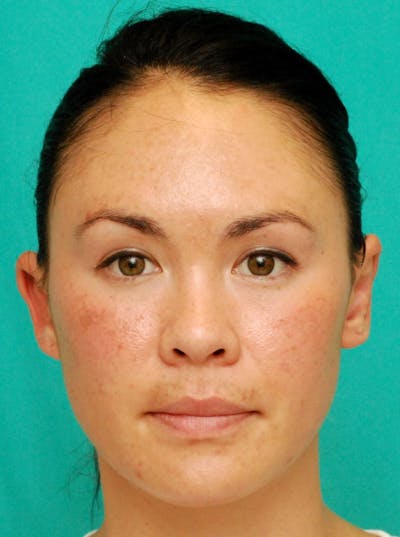 Ear Surgery Before & After Gallery - Patient 340840 - Image 2