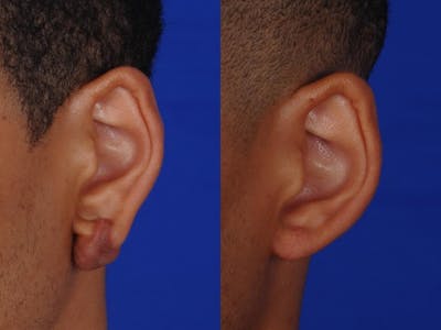 Ear Surgery Before & After Gallery - Patient 117603 - Image 1
