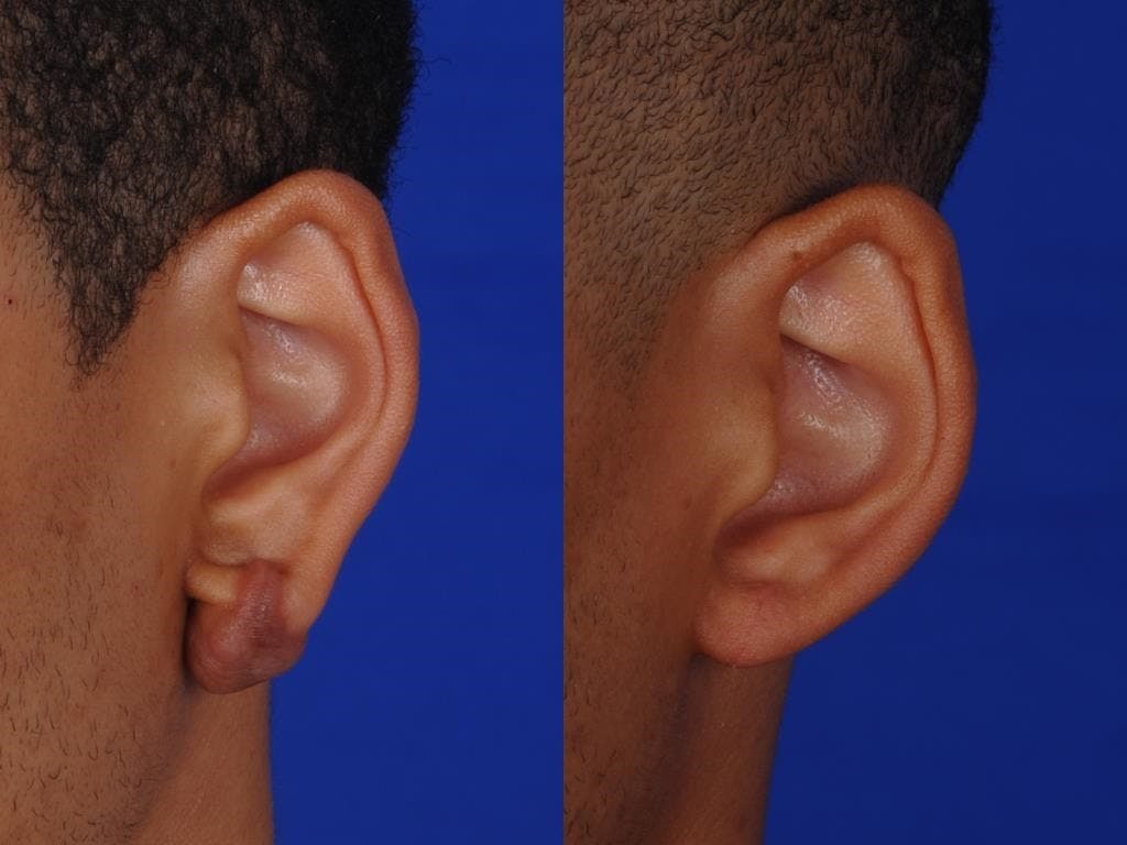 Ear Surgery Before & After Gallery - Patient 117603 - Image 1