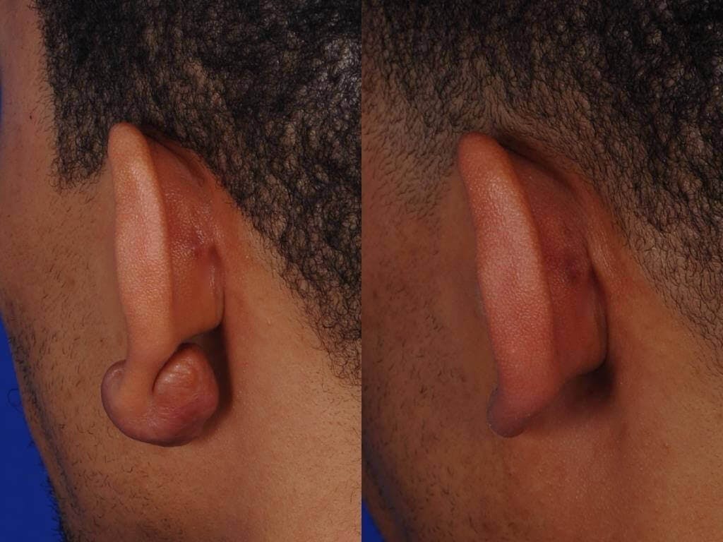 Ear Surgery Before & After Gallery - Patient 117603 - Image 2