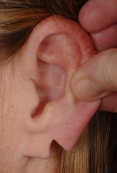 Ear Surgery Before & After Gallery - Patient 283618 - Image 1