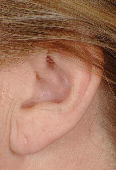 Ear Surgery Before & After Gallery - Patient 283618 - Image 2