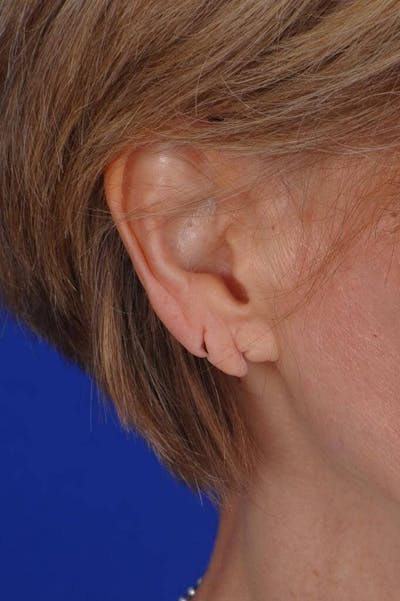Ear Surgery Before & After Gallery - Patient 229941 - Image 1