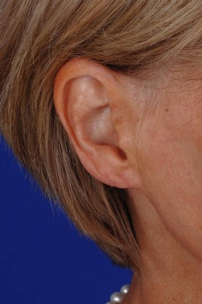 Ear Surgery Before & After Gallery - Patient 229941 - Image 2