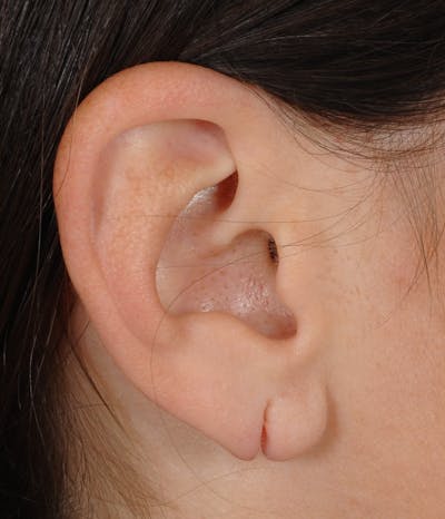 Ear Surgery Before & After Gallery - Patient 422610 - Image 1
