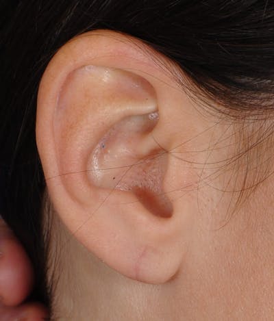 Ear Surgery Before & After Gallery - Patient 422610 - Image 2