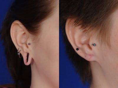 Ear Surgery Before & After Gallery - Patient 388356 - Image 1