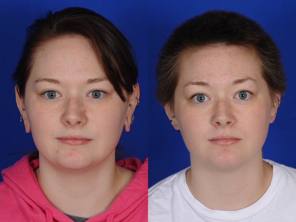 Ear Surgery Before & After Gallery - Patient 388356 - Image 2