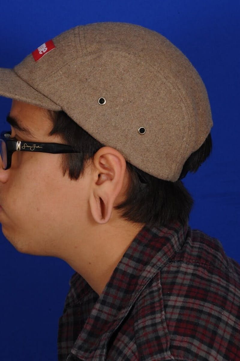 Ear Surgery Before & After Gallery - Patient 252215 - Image 3