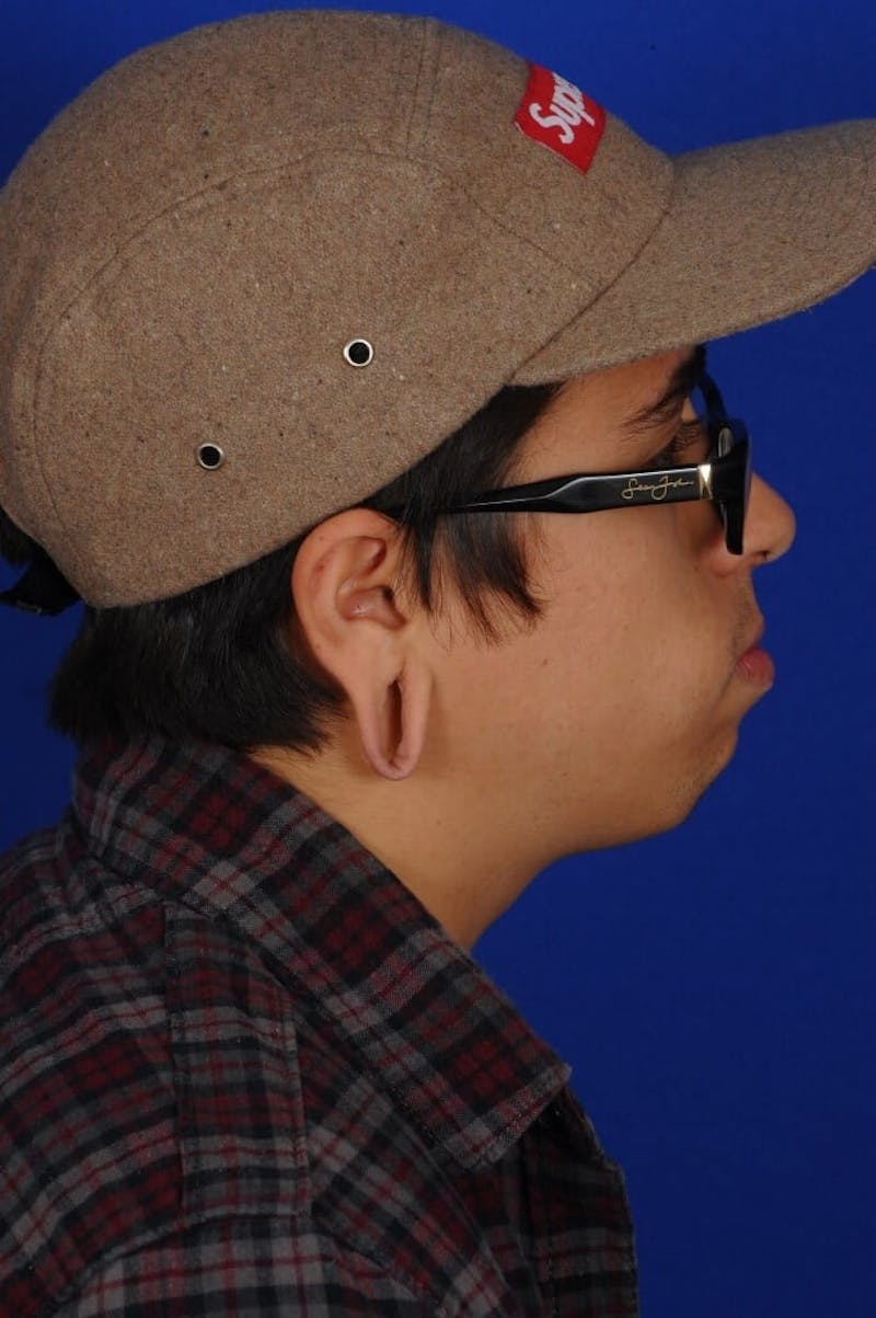 Ear Surgery Before & After Gallery - Patient 252215 - Image 5