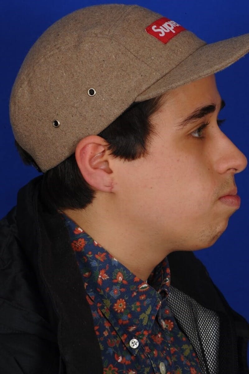 Ear Surgery Before & After Gallery - Patient 252215 - Image 6