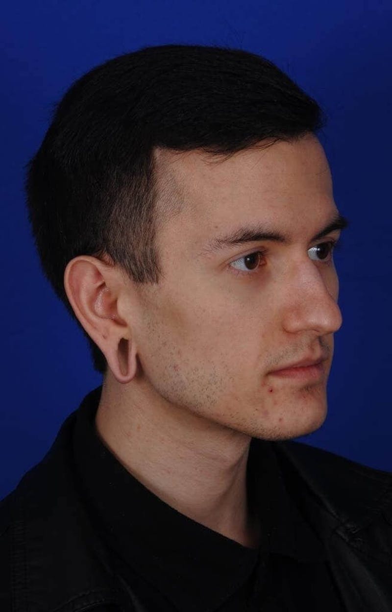 Ear Surgery Before & After Gallery - Patient 390673 - Image 3