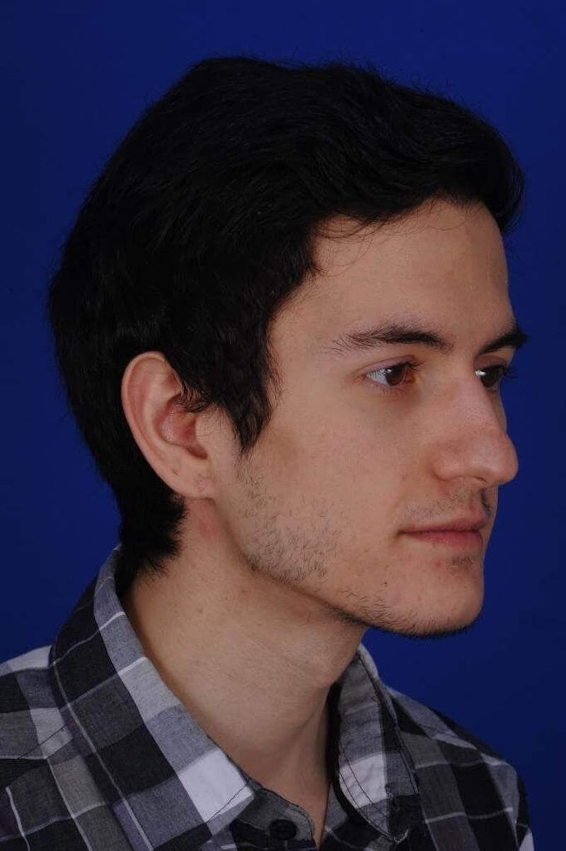 Ear Surgery Before & After Gallery - Patient 390673 - Image 4