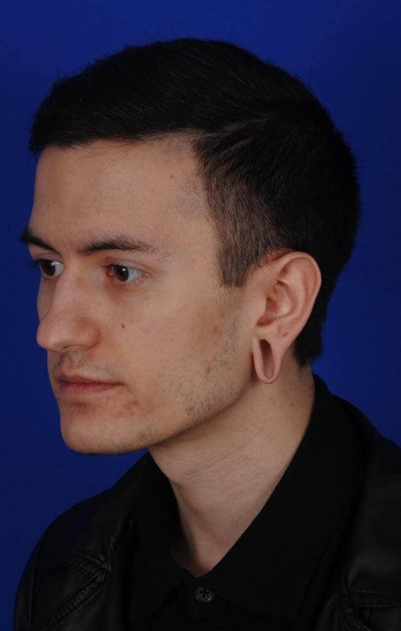Ear Surgery Before & After Gallery - Patient 390673 - Image 5