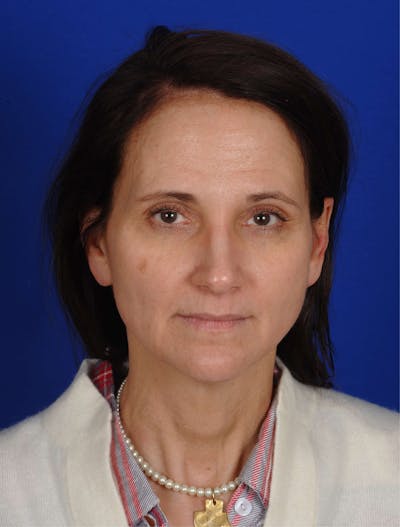 Hydrafacial MD Before & After Gallery - Patient 917701 - Image 2