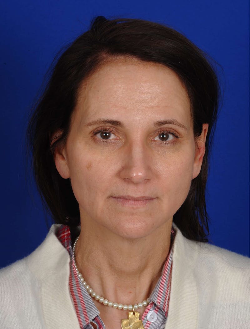 Hydrafacial MD Before & After Gallery - Patient 917701 - Image 2