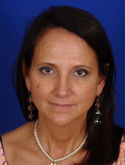 Hydrafacial MD Before & After Gallery - Patient 917701 - Image 1
