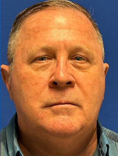 Laser Skin Resurfacing Before & After Gallery - Patient 151357 - Image 1