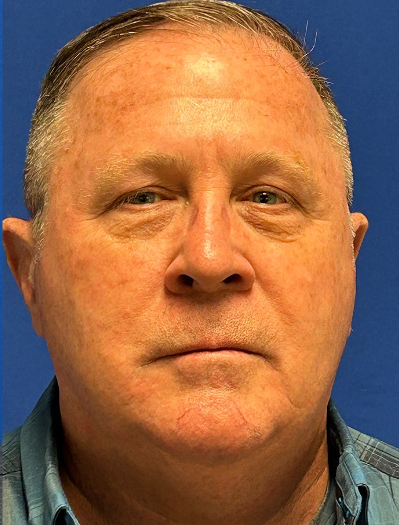 Laser Skin Resurfacing Before & After Gallery - Patient 151357 - Image 1
